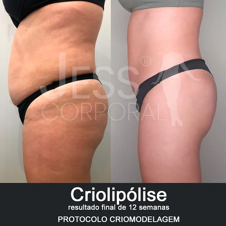 Resultado de protocolo corporal realizado na Jess Corporal